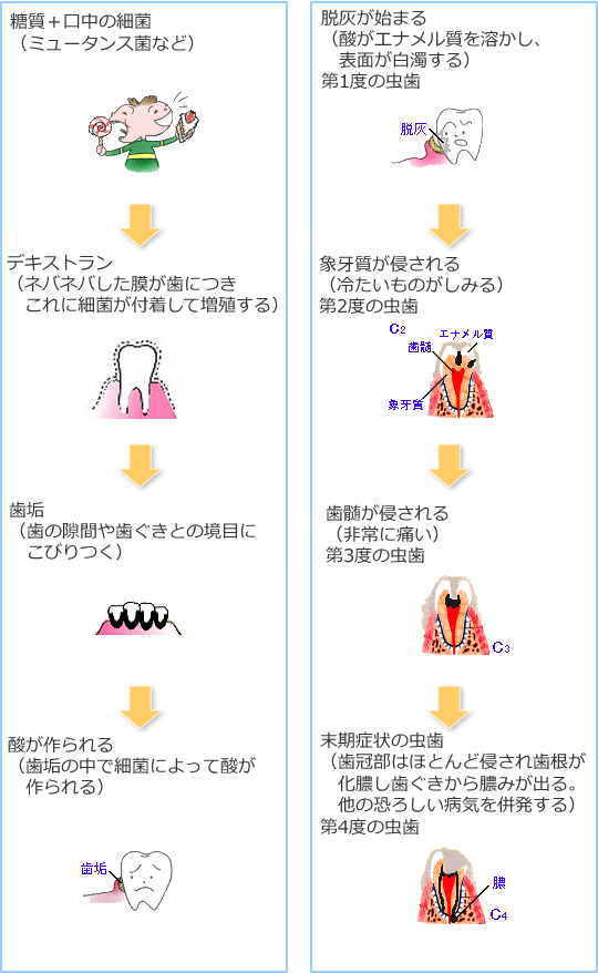 むし歯の進行